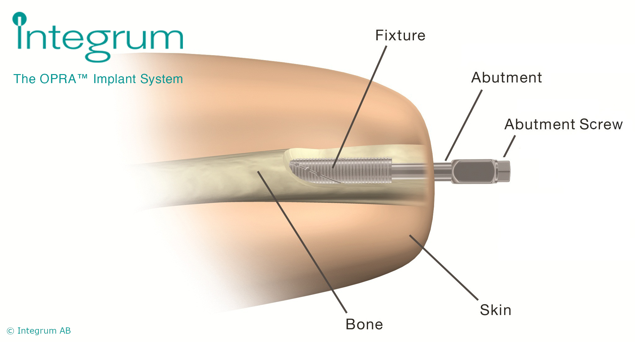 The OPRA™ Implant System